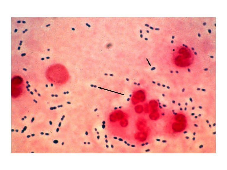 Bakteri Penyebab Sinusitis