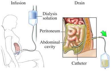 pembatasan asupan cairan dialisis peritoneal